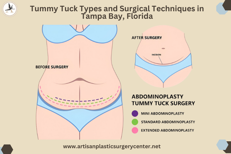 Tummy Tuck Types and Surgical Techniques in Tampa Bay, Florida
