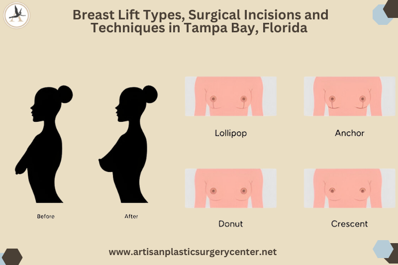 Breast Lift Types, Surgical Incisions and Techniques in Tampa Bay, Florida