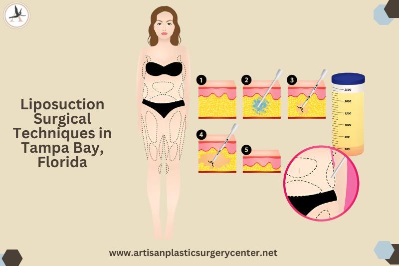 Liposuction Surgical Techniques in Tampa Bay, Florida