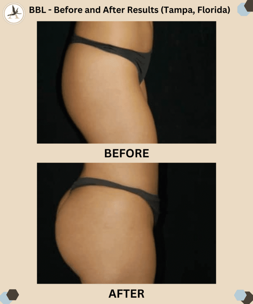 BBL - Before and After Results (Tampa, Florida)_How Long Does a Brazilian Butt Lift Last Maintain BBL Results