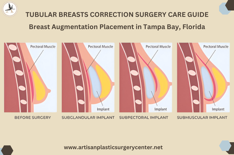 Tubular Breasts Correction Surgery Care Guide Breast Augmentation Placement in Tampa Bay, Florida