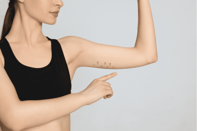 Why Are My Upper Arms Flabby? Best Arm Lift Treatment Options_How to Get Rid of Loose Skin on Your Arms