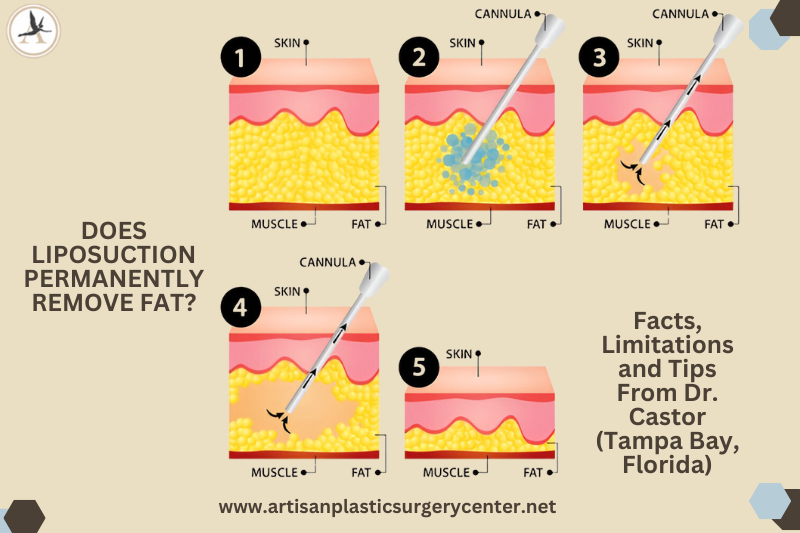 Does Liposuction Permanently Remove Fat What You Need to Know Facts, Limitations and Tips From Dr. Castor