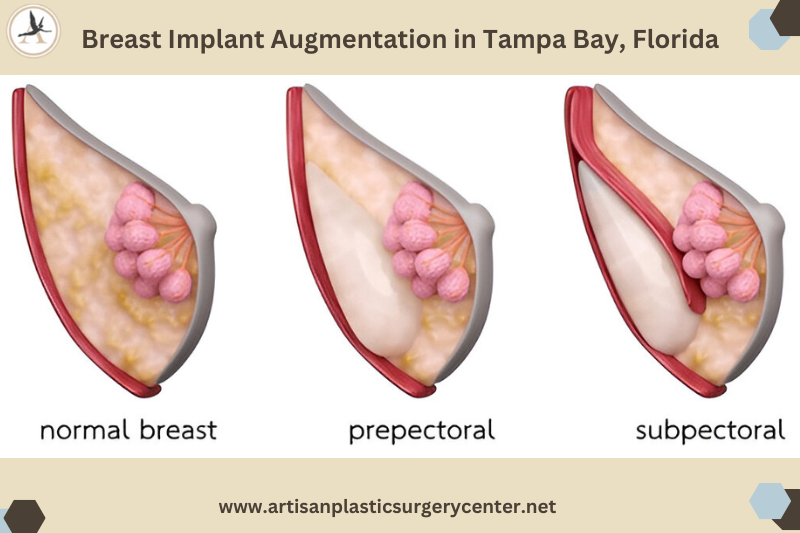 Breast Implant Augmentation in Tampa Bay, Florida