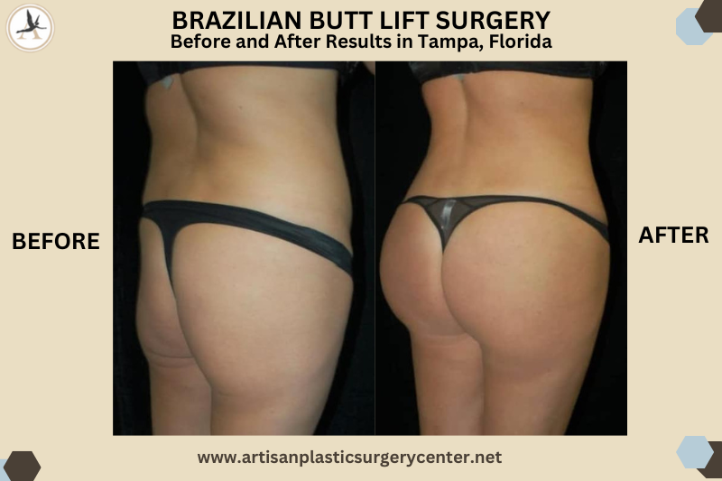 Brazilian Butt Lift Surgery - Before and After Results in Tampa, Florida_3 Things To Avoid After Your BBL - Recovery Essentials to Protect Your BBL Results