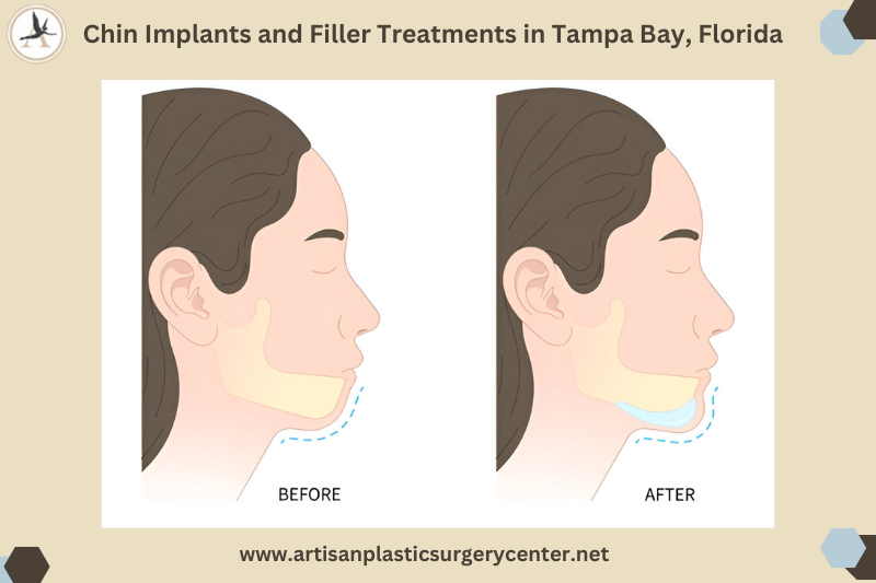 Can You Fix a Weak Chin Chin Implants and Filler Treatments in Tampa Bay, Florida