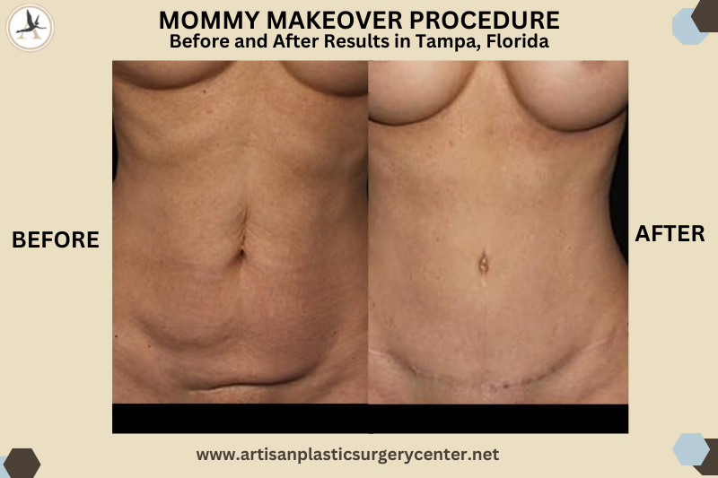 MOMMY MAKEOVER PROCEDURE Before and After Results in Tampa, Florida_Getting a Mommy Makeover - Women Cosmetic Surgery