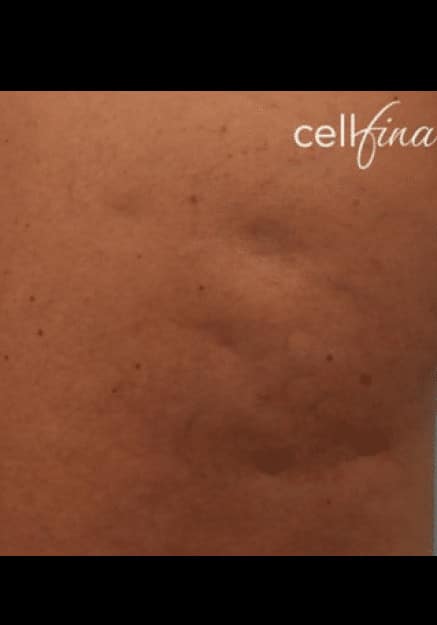 Cellfina Before