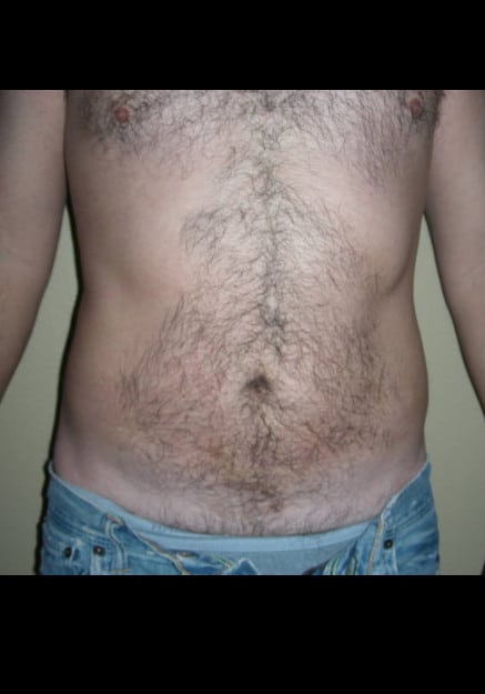 Vaser Liposelection Tampa - After Image 2