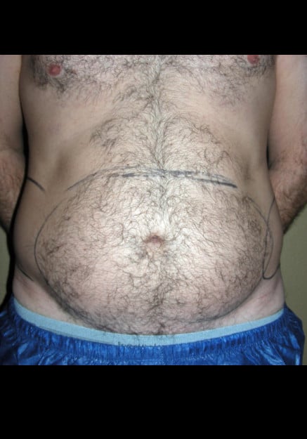 Vaser Liposelection Tampa - Before Image 1