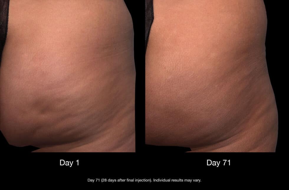 Before and after QWO injections New York NY 980x643 1