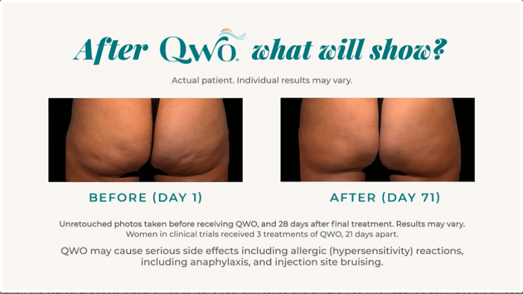 after qwo what will show 760x428 1