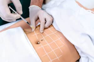 Artisan Aesthetics Plastic Surgery Laser Center liposuction treatment