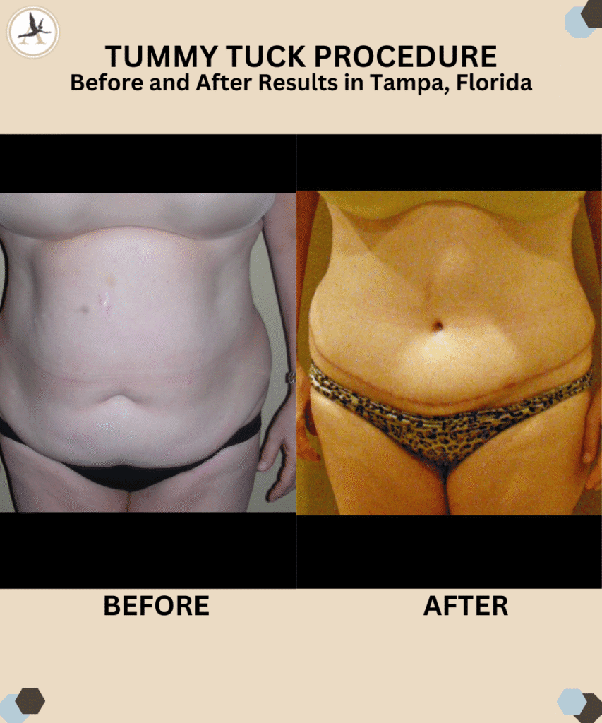 Tummy Tuck Before and After Results in Tampa, Florida_Transform Your Appearance With a Tummy Tuck - Benefits Guide