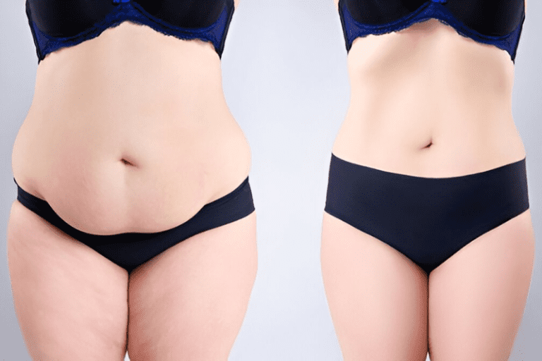 Factors Before Having a Tummy Tuck - Factors Before Having a Tummy Tuck - Considerations and Tips