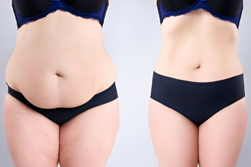 3 Factors Before Having a Tummy Tuck - Stable Weight Is the Key