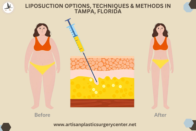 Liposuction Options, Techniques & Methods in Tampa, Florida_Which Type of Liposuction Is the Best for My Goals Lipo Methods