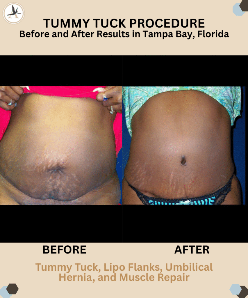 Tummy Tuck Before and After Results in Tampa Bay, Florida_Factors Before Having a Tummy Tuck - Considerations and Tips