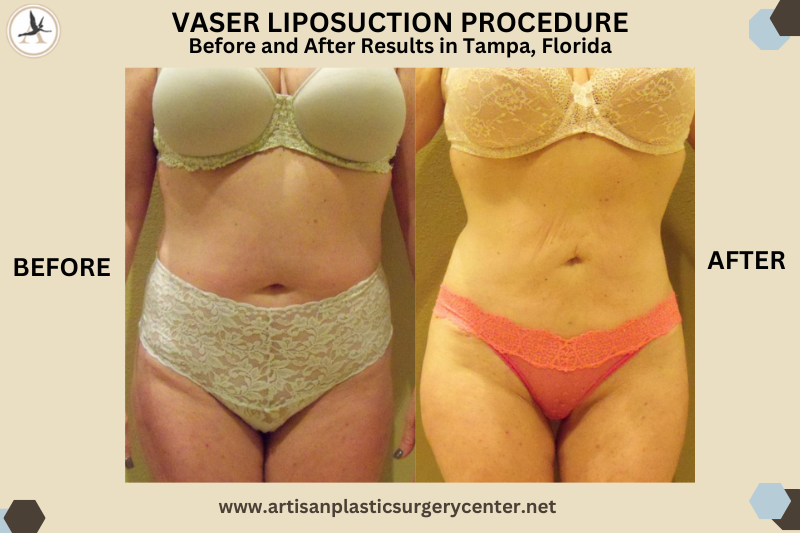 Vaser Liposuction procedure Before and After Results in Tampa, Florida_Which Type of Liposuction Is the Best for My Goals Lipo Methods