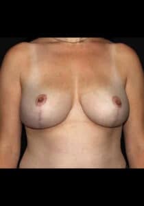 Breast Lift – Case 17