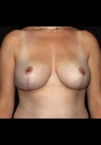 After Image: Breast Lift – Case 17