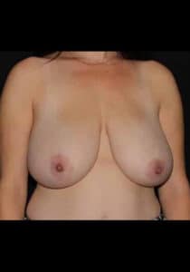 Before Image: Breast Lift – Case 17