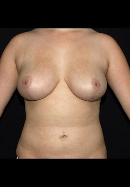 Breast Lift – Case 18