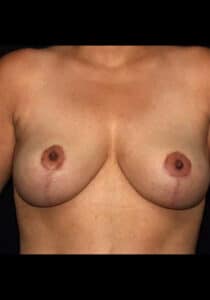 Breast Lift – Case 19