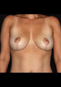 Breast Lift – Case 20