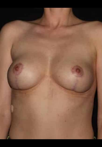 Breast Lift – Case 21