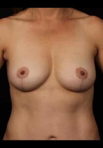Breast Lift – Case 22