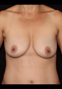 Before Image: Breast Lift – Case 22