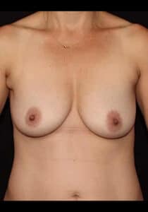 Breast Lift – Case 22