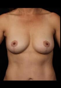 Breast Lift – Case 23