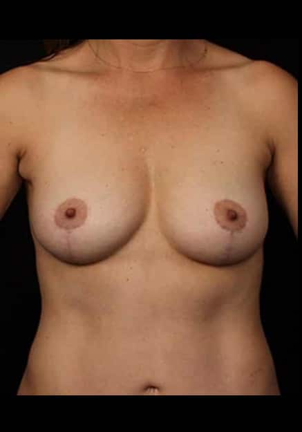 Breast Lift – Case 23