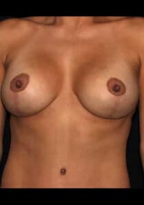 Breast Lift/Implants – Case 24