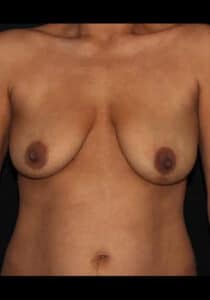 Breast Lift/Implants – Case 24