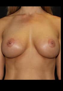 Breast Lift/Implants Case 28