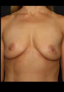 Before Image: Breast Lift/Implants Case 28