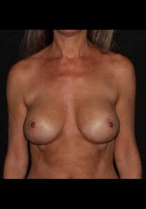 Breast Lift/Implants Case 29