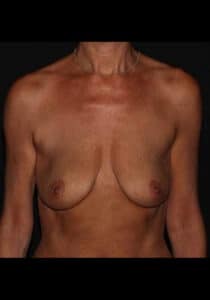 Breast Lift/Implants – Case 29