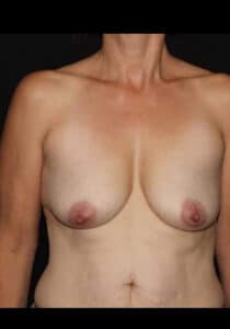 Before Image: Breast Lift/Implants – Case 33