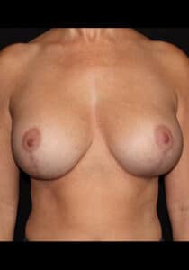 After Image: Breast Lift/Implants – Case 34