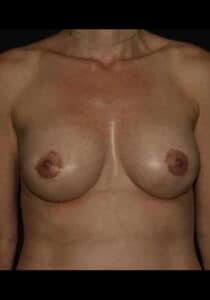 After Image: Breast Implant Revision – Case 1