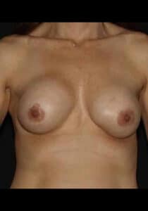 Before Image: Breast Implant Revision – Case 1
