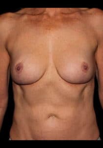 After Image: Breast Implant Removal – Case 2