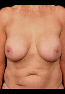 Breast Implant Removal – Case 2