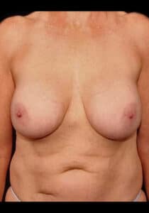 Before Image: Breast Implant Removal – Case 2
