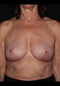 After Image: Breast Implant Removal – Case 3