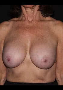 Before Image: Breast Implant Removal – Case 3